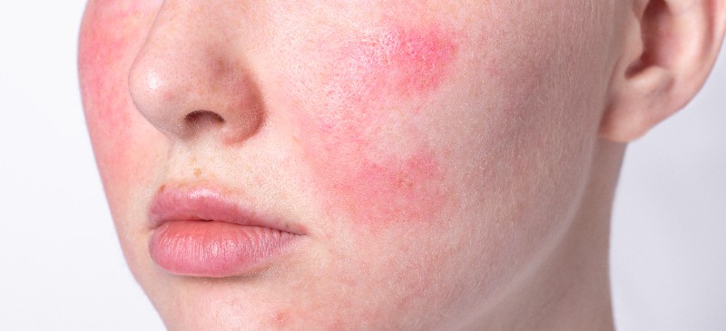 Rosacea treatment - Dr. Axe